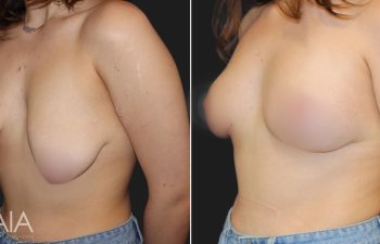 20 year-old before and 4 weeks after a breast lift