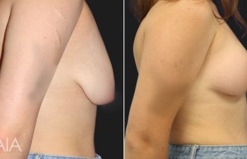 20 year-old before and 4 weeks after a breast lift