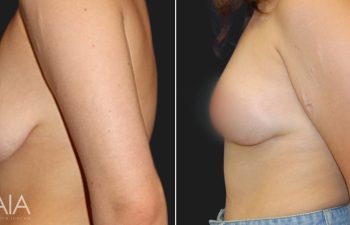 20 year-old before and 4 weeks after a breast lift