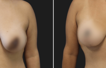 36 year-old mother of 2 before and 5 months after a tummy tuck with a hernia repair, liposuction of flanks and lower back, and a breast lift