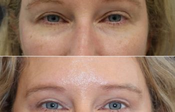 49 year-old before and 2 months after an upper eyelid lift