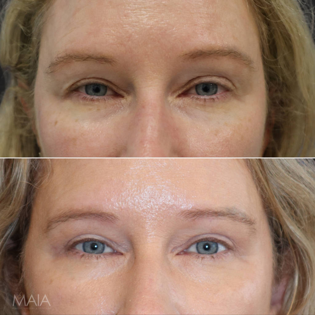 49 year-old before and 2 months after an upper eyelid lift