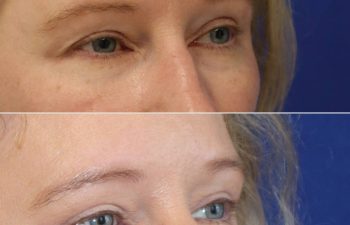 49 year-old before and 2 months after an upper eyelid lift
