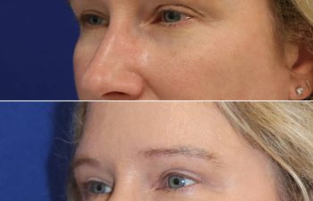 49 year-old before and 2 months after an upper eyelid lift