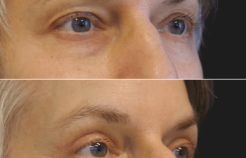 50 year-old before and 3 months after facial rejuvenation surgery: a facelift, neck lift, upper and lower blepharoplasty, and fat grafting to the face