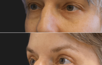 50 year-old before and 3 months after facial rejuvenation surgery: a facelift, neck lift, upper and lower blepharoplasty, and fat grafting to the face