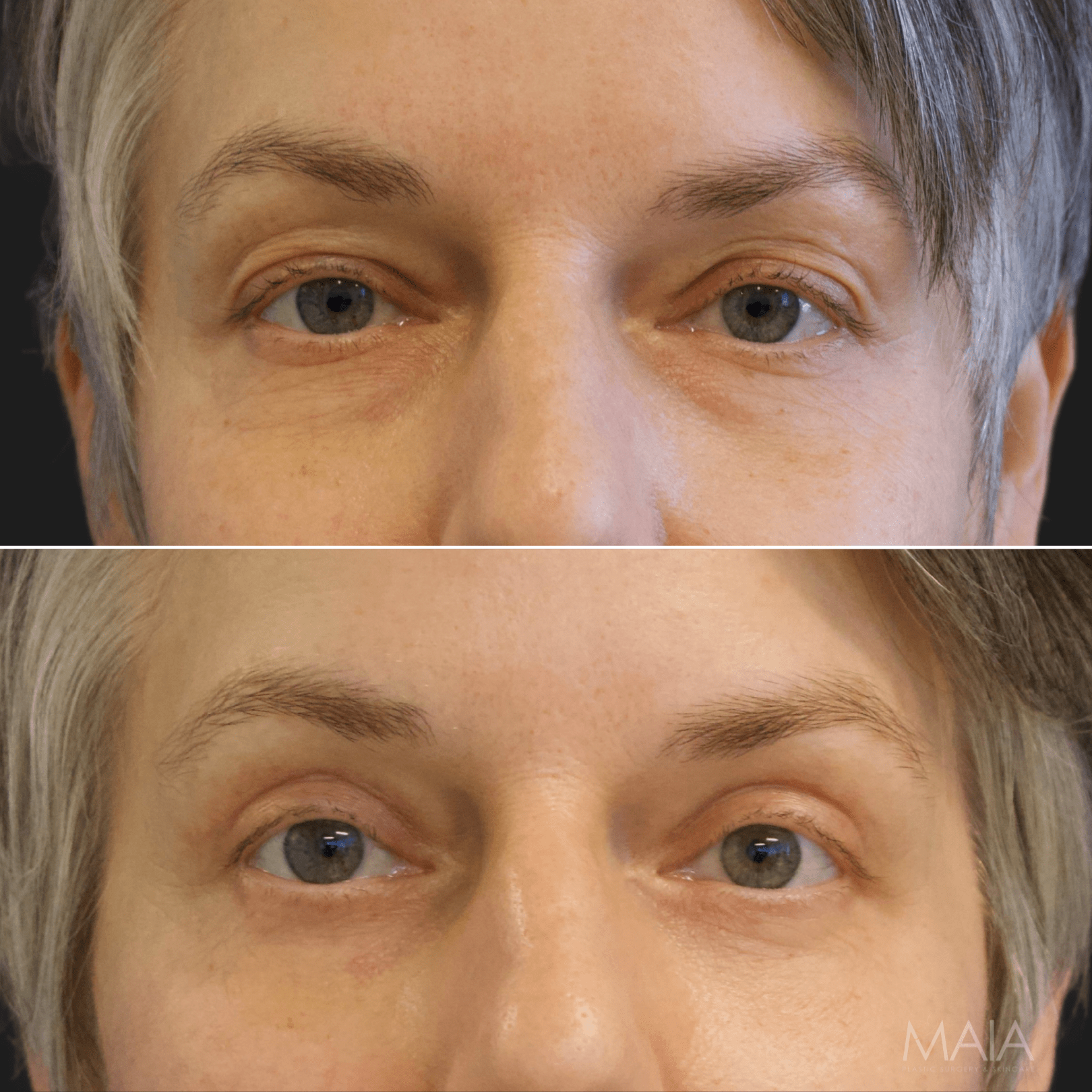 50 year-old before and 3 months after facial rejuvenation surgery: a facelift, neck lift, upper and lower blepharoplasty, and fat grafting to the face