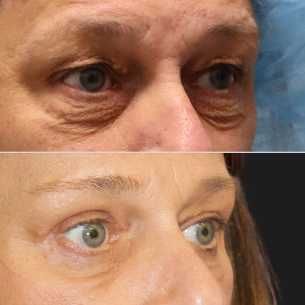 59 year-old before and after an upper eyelid lift, lower eyelid lift, and canthopexy