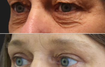 59 year-old before and after an upper eyelid lift, lower eyelid lift, and canthopexy