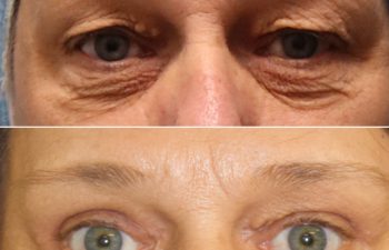 59 year-old before and after an upper eyelid lift, lower eyelid lift, and canthopexy