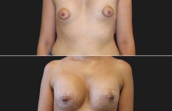 27 year-old with tuberous breasts before and 3 weeks after breast lift, breast augmentation with silicone implants (210 CC, Moderate Profile), and fat grafting to the breasts