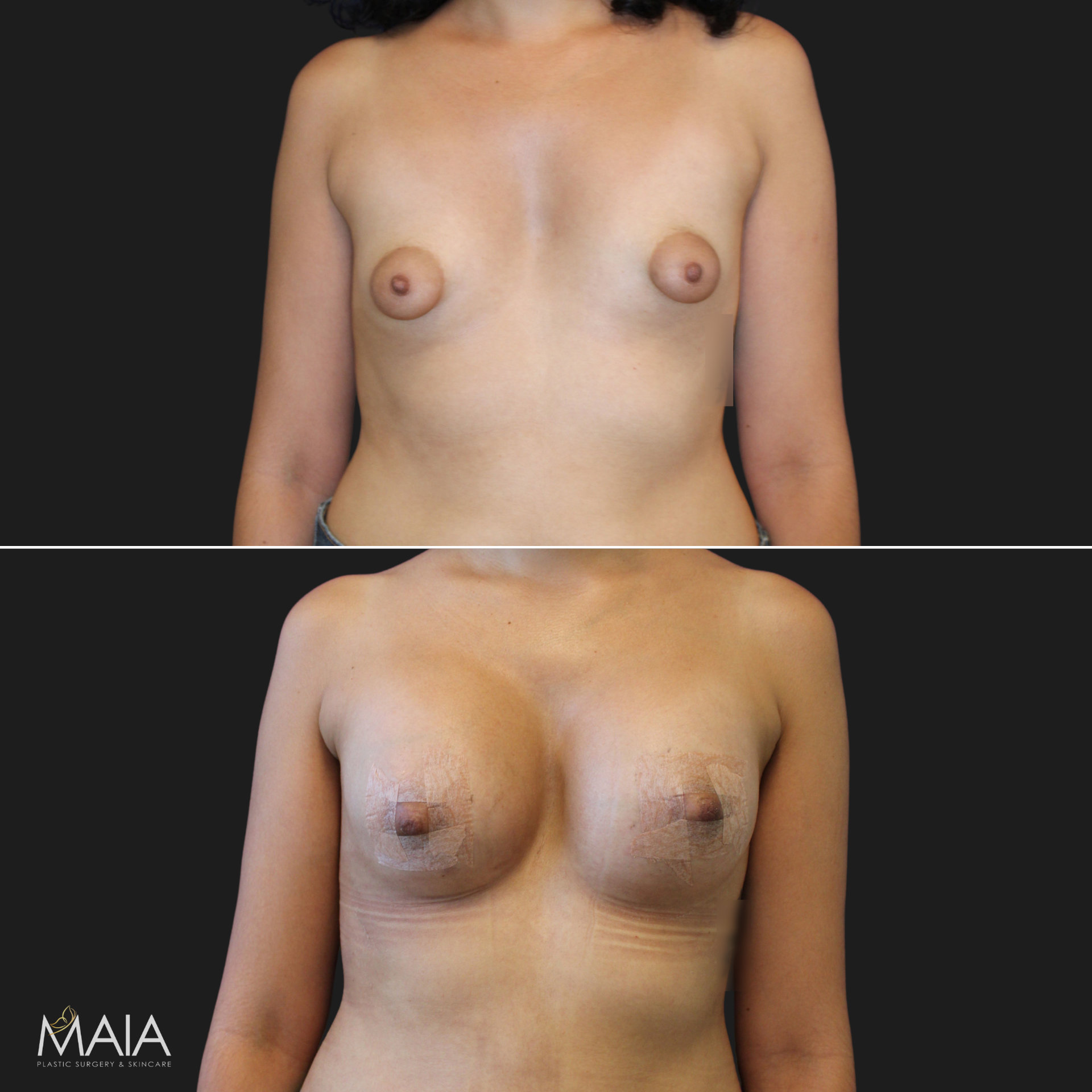 27 year-old with tuberous breasts before and 3 weeks after breast lift, breast augmentation with silicone implants (210 CC, Moderate Profile), and fat grafting to the breasts