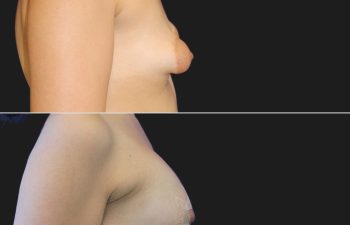 27 year-old with tuberous breasts before and 3 weeks after breast lift, breast augmentation with silicone implants (210 CC, Moderate Profile), and fat grafting to the breasts