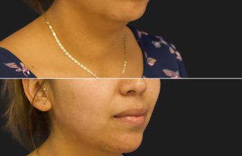 female before and after chin and jawline filler