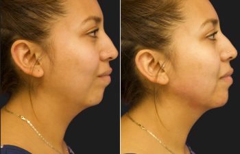 female before and after chin and jawline filler