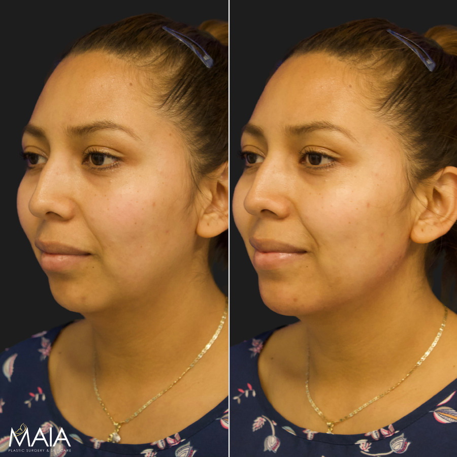 female before and after chin and jawline filler