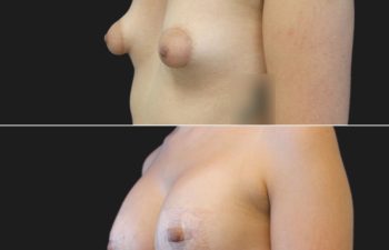 27 year-old with tuberous breasts before and 3 weeks after breast lift, breast augmentation with silicone implants (210 CC, Moderate Profile), and fat grafting to the breasts