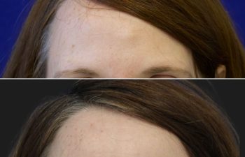 46 year-old female with forehead osteoma before and after osteoma removal