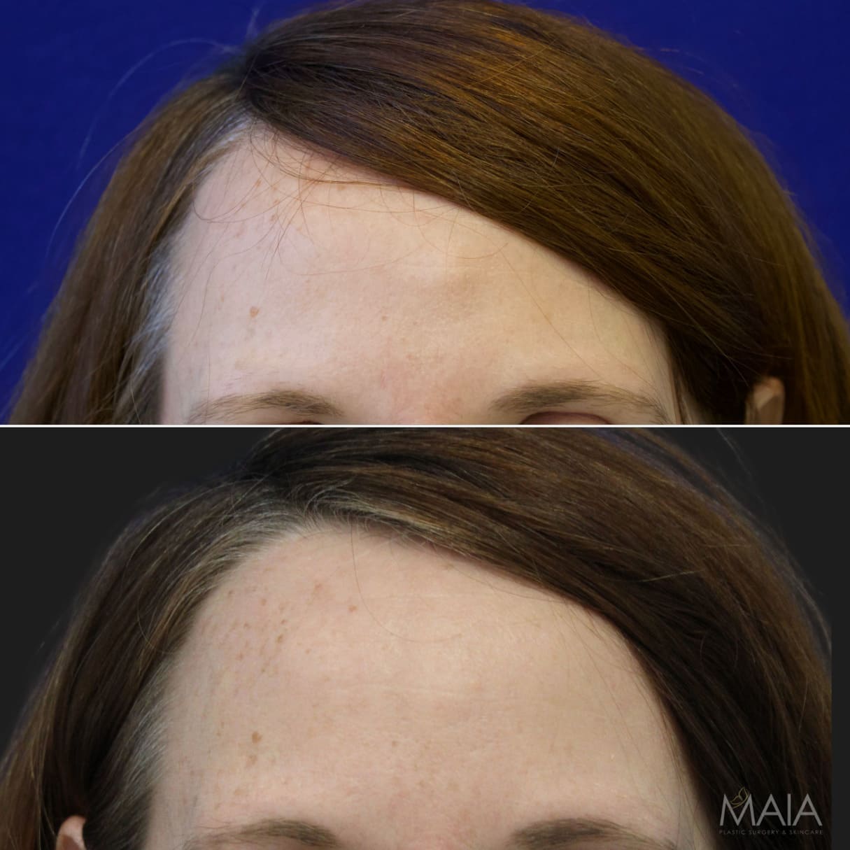 46 year-old female with forehead osteoma before and after osteoma removal