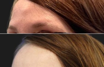 46 year-old female with forehead osteoma before and after osteoma removal