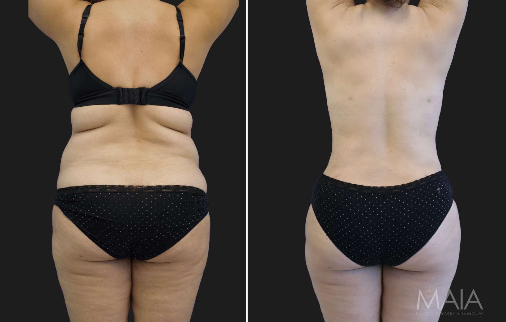 🥇 Liposuction  Maia Plastic Surgery