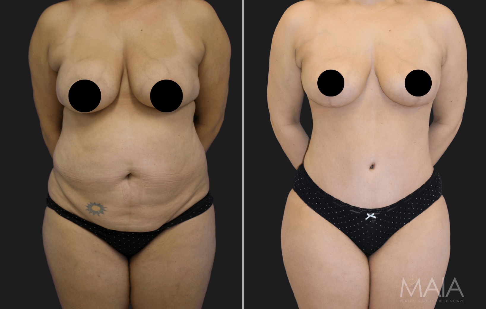 Lower Body Lift vs Tummy Tuck