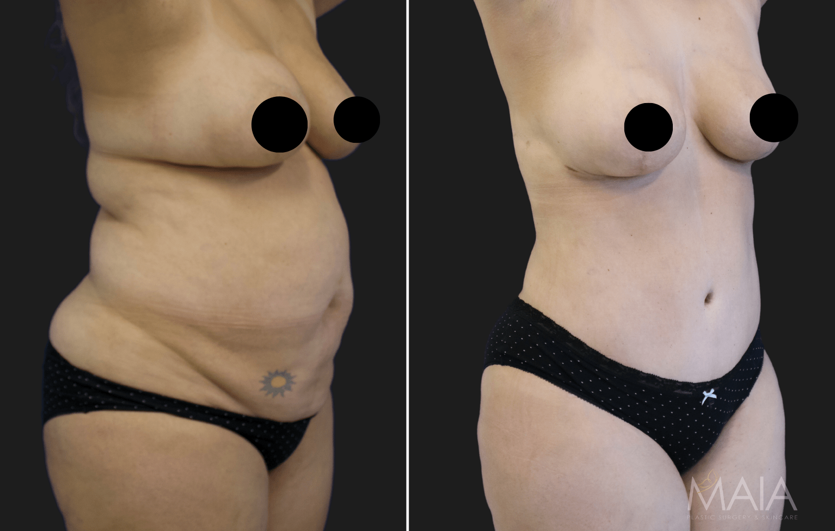 TUMMY TUCK (ABDOMINOPLASTY) - Hall & Wrye – Plastic Surgery and Medical Spa  in Reno NV, Breast Implants and Breast Augmentation, Liposuction, Tummy- Tucks, Dermal Fillers, Hair Transplants and more! Licensed Reno Plastic