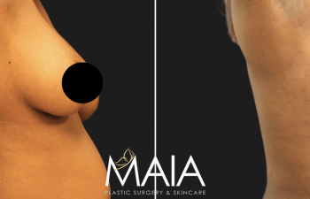 49 year-old patient before and 4 months after a tummy tuck, flanks liposuction, and a breast reduction