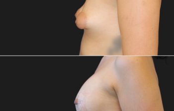 27 year-old with tuberous breasts before and 3 weeks after breast lift, breast augmentation with silicone implants (210 CC, Moderate Profile), and fat grafting to the breasts