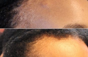 53 year-old female with forehead osteoma before and after osteoma removal