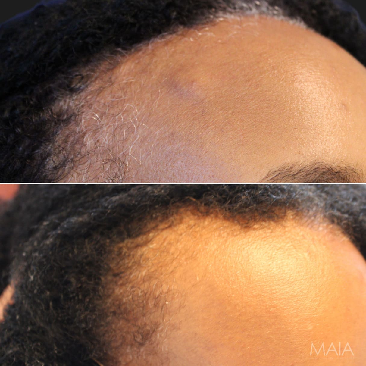 53 year-old female with forehead osteoma before and after osteoma removal