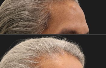 53 year-old male with forehead osteoma for ten years; Before and after osteoma removal