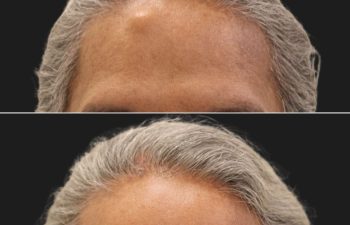 53 year-old male with forehead osteoma for ten years; Before and after osteoma removal