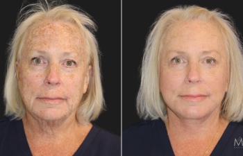 63 year-old before and 2 months after customized facial rejuvenation Facelift, neck lift, upper and lower blepharoplasty, a TCA peel, and medical-grade skincare