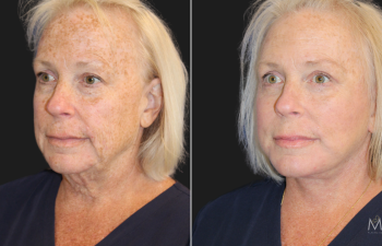 63 year-old before and 2 months after customized facial rejuvenation_ Facelift, neck lift, upper and lower blepharoplasty, a TCA peel, and medical-grade skincare