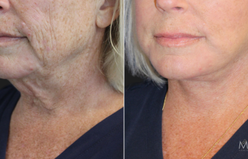 63 year-old before and 2 months after customized facial rejuvenation_ Facelift, neck lift, upper and lower blepharoplasty, a TCA peel, and medical-grade skincare