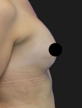 After Tuberous Breast Correction (210 CC, Silicone)