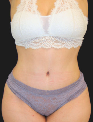 After Tummy Tuck and Flank Liposuction