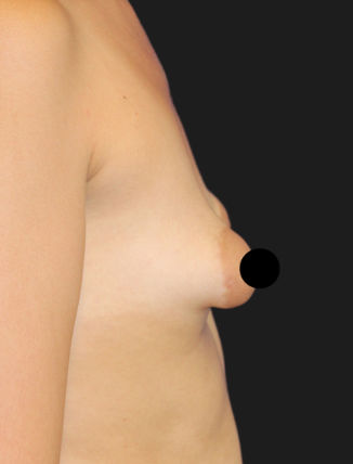 Before Tuberous Breast Correction (210 CC, Silicone)