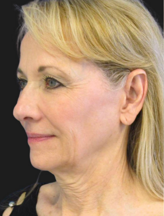 before Facelift & Neck Lift (Custom Facial Rejuvenation)