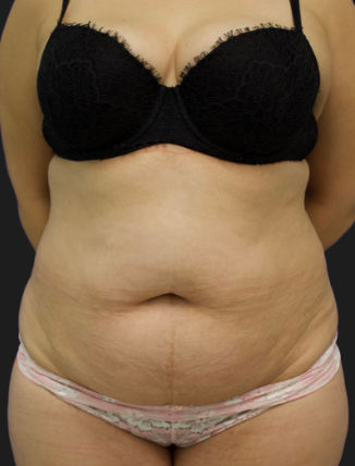 Before Tummy Tuck and Flank Liposuction