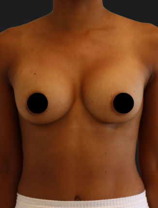 After Breast Augmentation (275 CC, SRM)