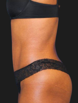 After Tummy Tuck and Flank Liposuction