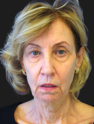 before Facelift & Neck Lift (Custom Facial Rejuvenation)