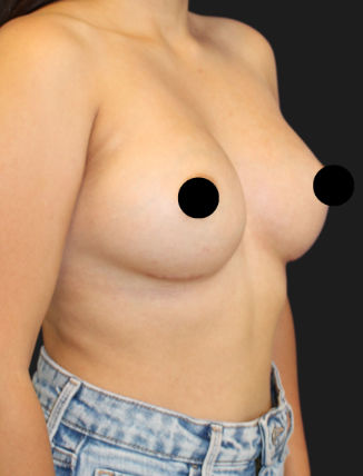 After Breast Augmentation (295 CC, Gummy Bear Implants)