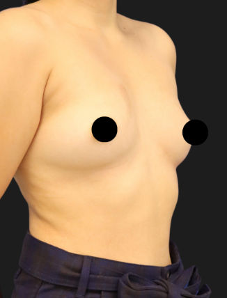 Before Breast Augmentation (295 CC, Gummy Bear Implants)