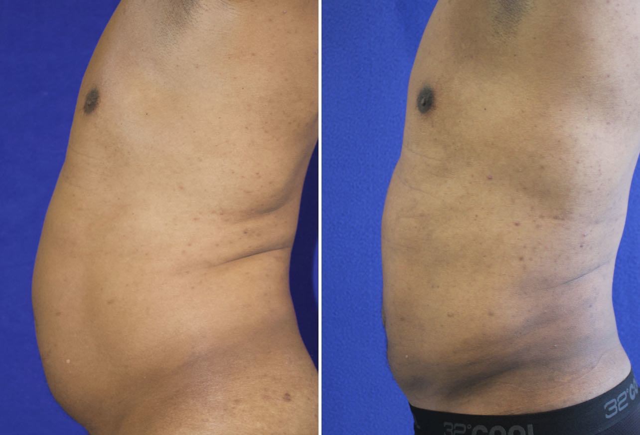 59 year-old male before and 3 months after liposuction of the abdomen and flanks
