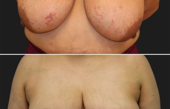 55 year-old patient before and 4 months after a breast reduction.