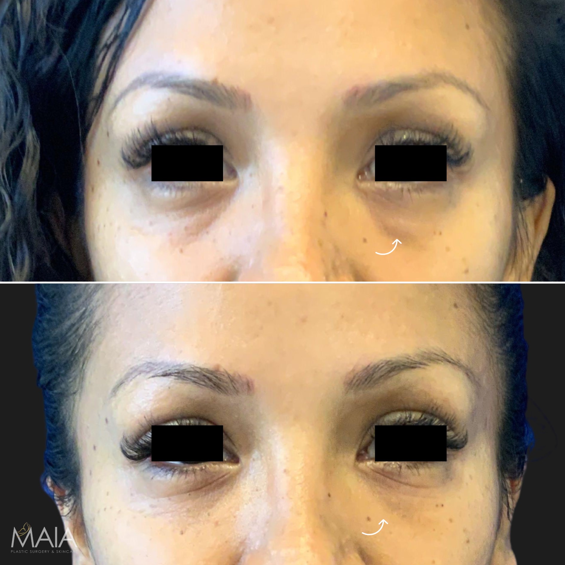 39 year-old female before and after under-eye filler