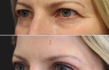 47 year-old before and after Eyelid Surgery (Upper) and Crow's Feet Botox